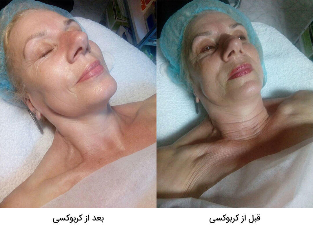 قبل و بعد کربوکسی تراپی - اثرات ژل کربوکسی