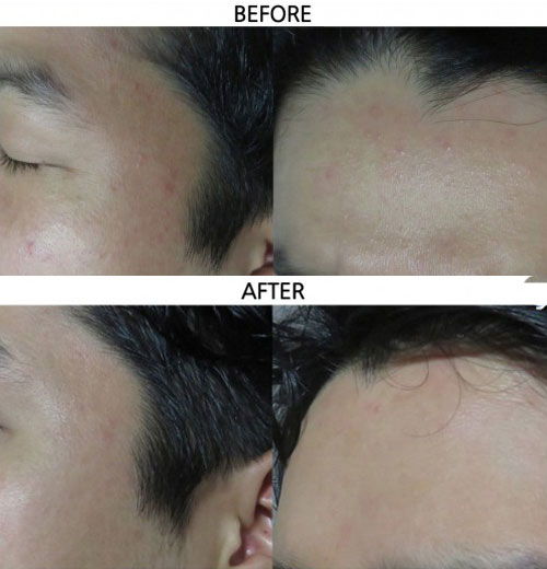 Carboxy rib skin gel