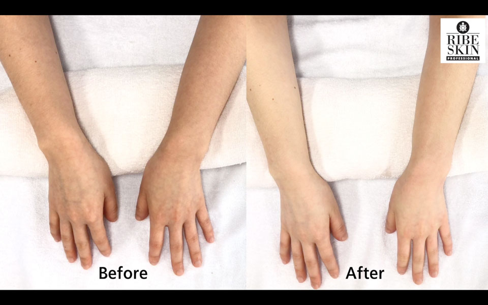 Carboxy rib skin gel