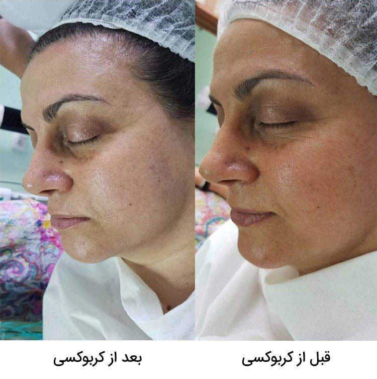 مزایای استفاده از ژل Carboxytherapy ریب اسکین ribskin
