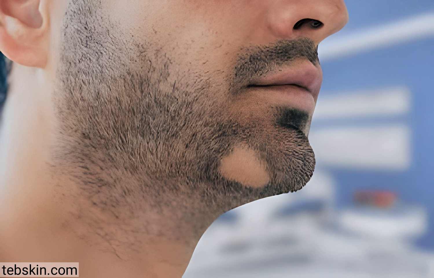 آلوپسی در ریش مردان